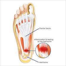 Location of planter fasciitis in the foot